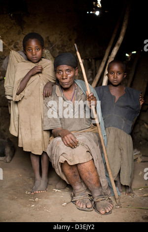 SORO città, zona WOLAYITA, sud Etiopia, 19AGOSTO 2008: Abavitch Mollory, dell'età di circa 50, ha elephantiasis e presenta a mendicare Foto Stock