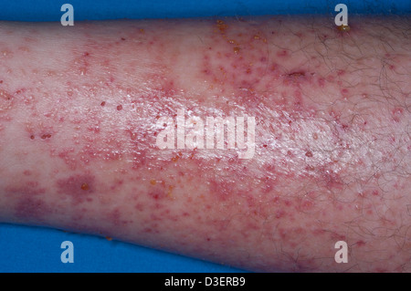 Poison Ivy dermatis rash sulla gamba Foto Stock