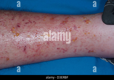 Poison Ivy dermatis rash sulla gamba Foto Stock