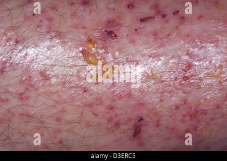 Poison Ivy dermatis rash sulla gamba Foto Stock