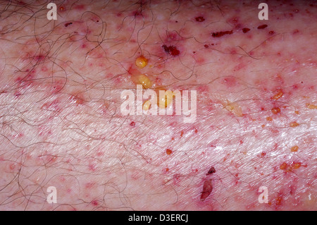 Poison Ivy dermatis rash sulla gamba Foto Stock