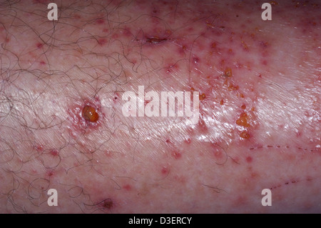 Poison Ivy dermatis rash sulla gamba Foto Stock