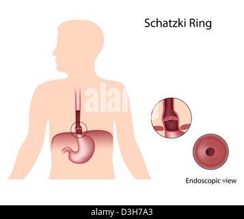 Anello di Schatzki blocchi esofago Foto Stock