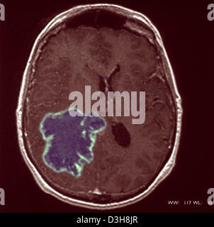 Cervello CARDIA, MRI Foto Stock