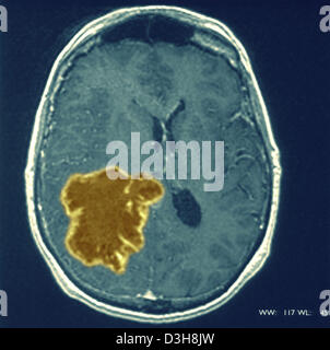 Cervello CARDIA, MRI Foto Stock