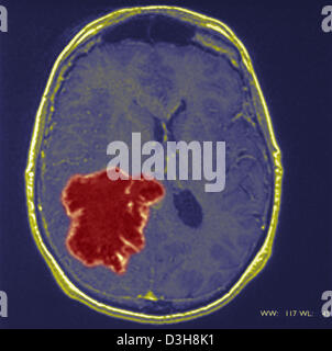 Cervello CARDIA, MRI Foto Stock