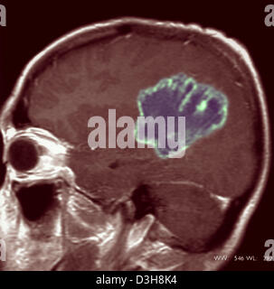 Cervello CARDIA, MRI Foto Stock