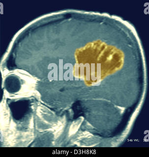 Cervello CARDIA, MRI Foto Stock