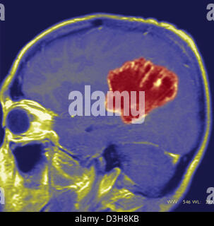 Cervello CARDIA, MRI Foto Stock