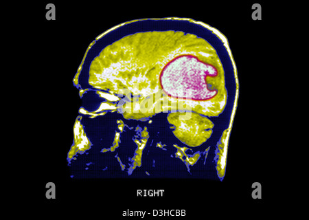 Cervello CARDIA, MRI Foto Stock