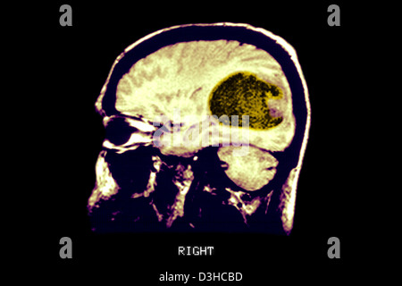 Cervello CARDIA, MRI Foto Stock