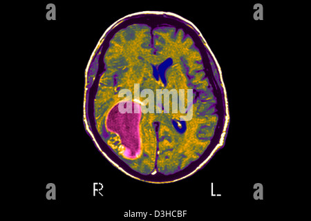 Cervello CARDIA, MRI Foto Stock