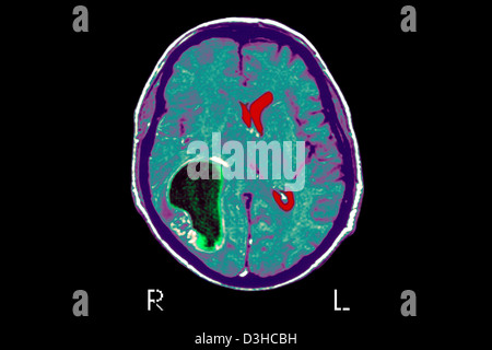 Cervello CARDIA, MRI Foto Stock