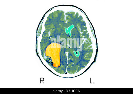 Cervello CARDIA, MRI Foto Stock