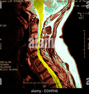 Artrosi cervicale, MRI Foto Stock