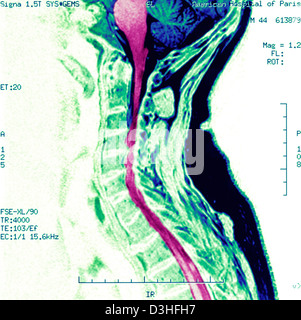 Artrosi cervicale, MRI Foto Stock