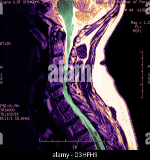 Artrosi cervicale, MRI Foto Stock