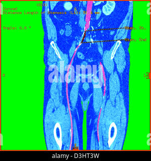 AORTA ADDOMINALE stenosi, scansione Foto Stock