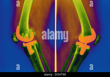 Protesi di ginocchio, RAGGI X Foto Stock