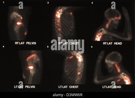 Scansione di osso che mostra più metastasi Foto Stock