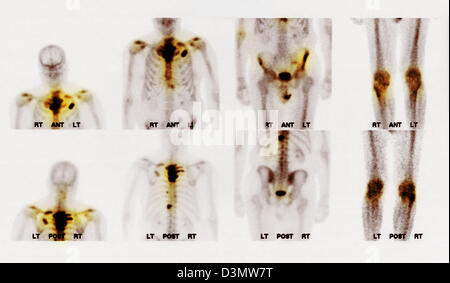 Scansione di osso che mostra più metastasi Foto Stock