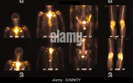 Scansione di osso che mostra più metastasi Foto Stock