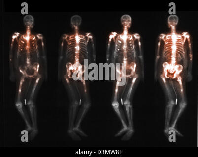 Scansione di osso che mostra più metastasi Foto Stock