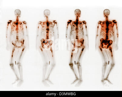 Scansione di osso che mostra più metastasi Foto Stock