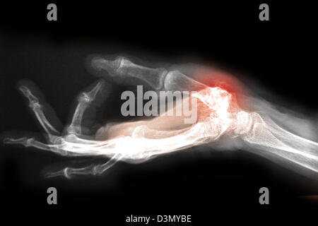 Mano x-ray di un uomo anziano che mostra degenerative malattia artritica alla base del pollice metacarpale Foto Stock