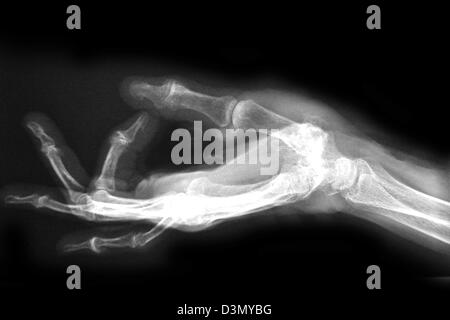 Mano x-ray di un uomo anziano che mostra degenerative malattia artritica alla base del pollice metacarpale Foto Stock