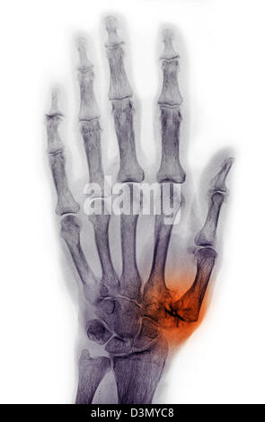 Mano x-ray di un uomo anziano che mostra degenerative malattia artritica alla base del pollice metacarpale Foto Stock