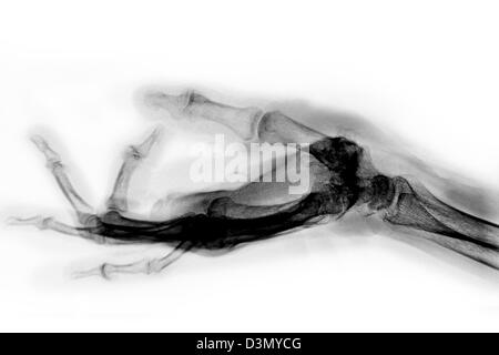 Mano x-ray di un uomo anziano che mostra degenerative malattia artritica alla base del pollice metacarpale Foto Stock