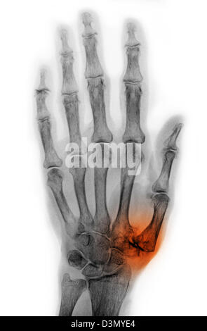 Mano x-ray di un uomo anziano che mostra degenerative malattia artritica alla base del pollice metacarpale Foto Stock