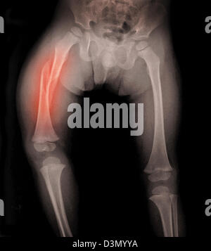 Raggi X che mostra una frattura del femore in un 3 anno vecchio ragazzo vittima di abusi sui minori Foto Stock