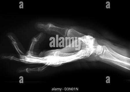 Mano x-ray di un uomo anziano che mostra degenerative malattia artritica alla base del pollice metacarpale Foto Stock