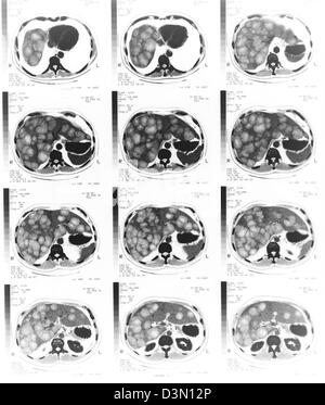 CT scan fette che mostra ampia metastasi del cancro del fegato Foto Stock