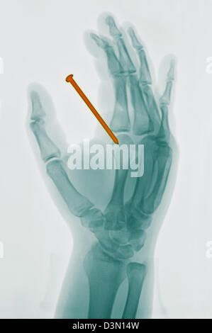 Mano x-ray di 26 anno vecchio che accidentalmente sparato un chiodo da una pistola sparachiodi attraverso la sua mano Foto Stock