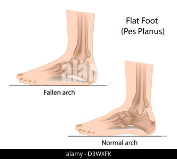 Piede piatto Foto Stock