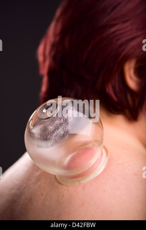 Close-up di una persona che riceve una depressione trattamento cupping Foto Stock