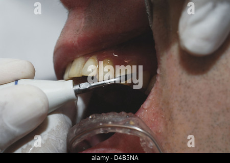 Dentista usando il raschiatore dentale lungo con specchio dentale per rimuovere la placca dai denti di pazienti Foto Stock