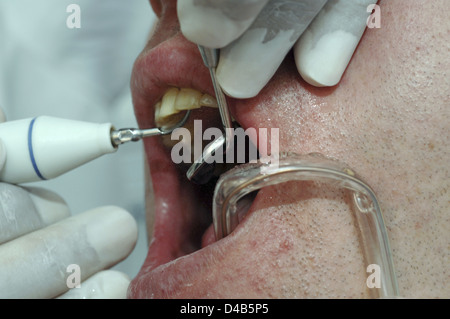 Dentista usando il raschiatore dentale lungo con specchio dentale ad esame delle condizioni dei pazienti denti Foto Stock