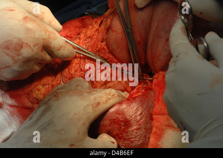 Chirurgo rimuovendo la milza ingrossata durante la chirurgia Foto Stock