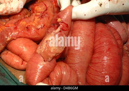 Adesione fibroso del colon Foto Stock