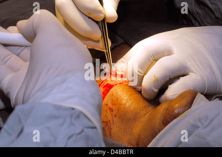 Il chirurgo accedere ghiandola tiroide nel collo platysma muscoli eseguire nel tessuto sottocutaneo del collo sono stati divisi possiamo vedere Foto Stock