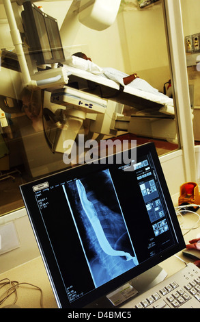 Pasto di bario procedura radiografie in esofago stomaco duodeno prelevato dopo il solfato di bario ingerito paziente pasti di bario utile Foto Stock