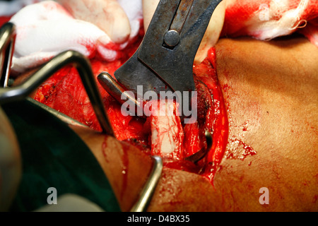 Close-up di un stomaco operazione di ernia che mostra diversi strumenti medici Foto Stock