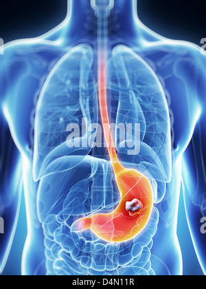 Stomaco - il cancro Foto Stock