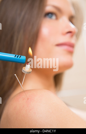 Moxibustione acupunture aghi calore sulla spalla donna closeup Foto Stock