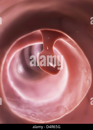 Polipo del colon Foto Stock