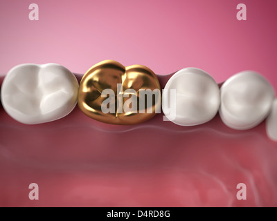 Dente d'oro Foto Stock